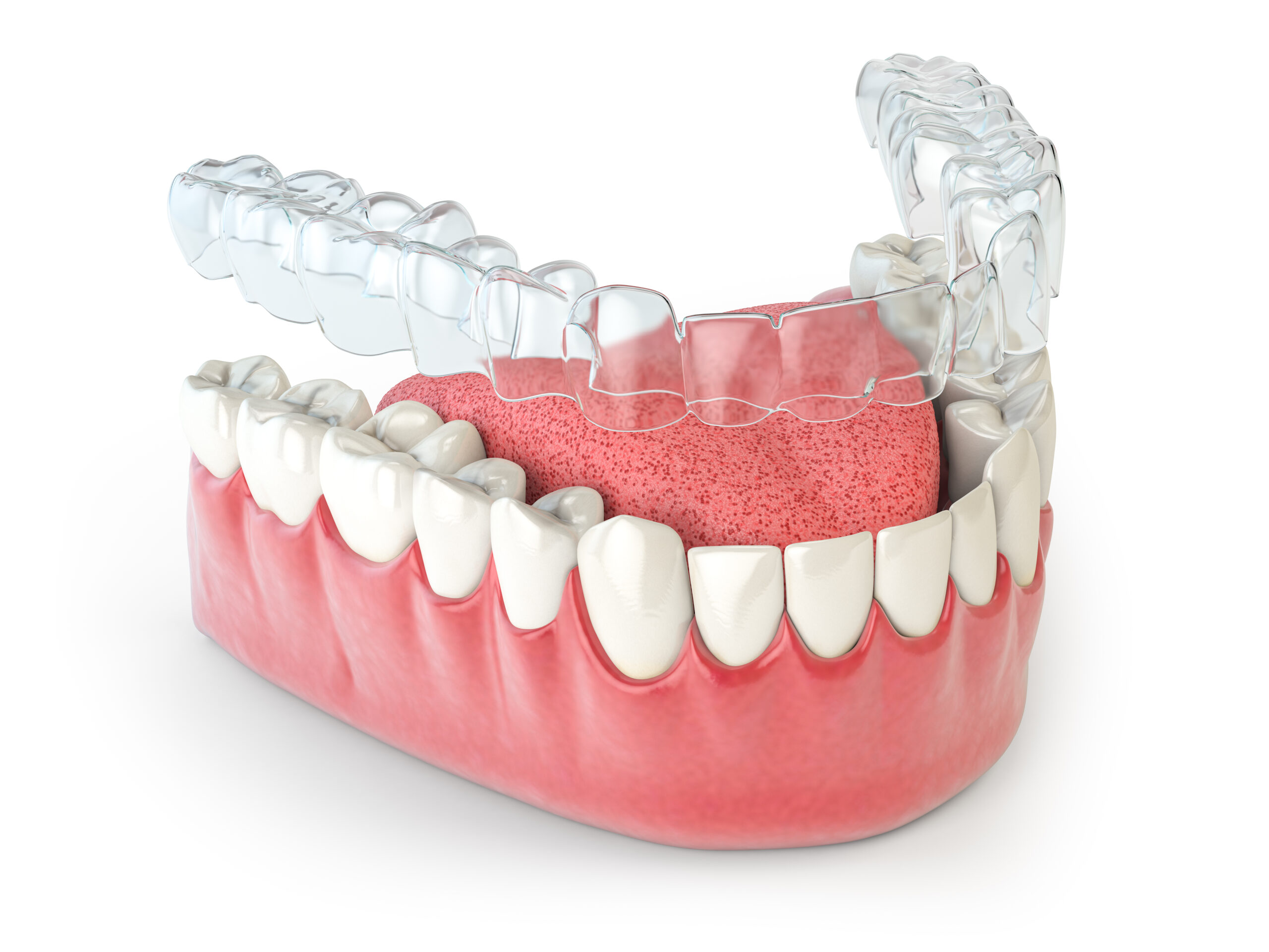 Invisalign treatment visual