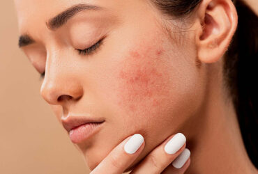 Acne Treatment