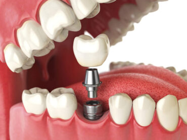 Dental Implants
