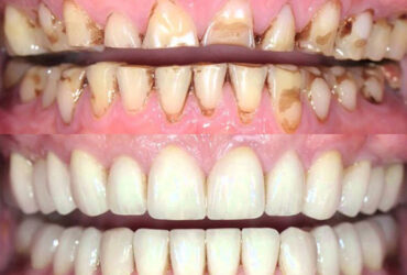Full Mouth Rehabilitation