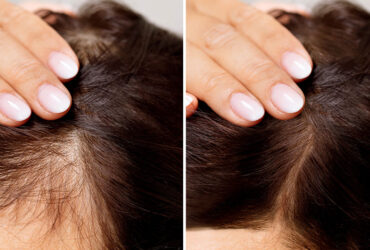 Hair Loss Treatment