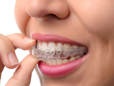 Invisible Braces & Invisalign