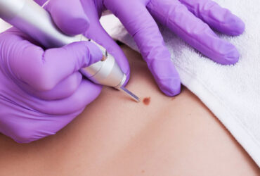 Mole & Wart Removal