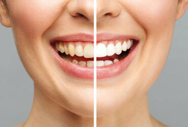 Teeth Whitening